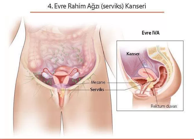 Rahim Agzi Kanseri Belirtileri Ve Tedavisi Prof Dr Mustafa Ozdogan